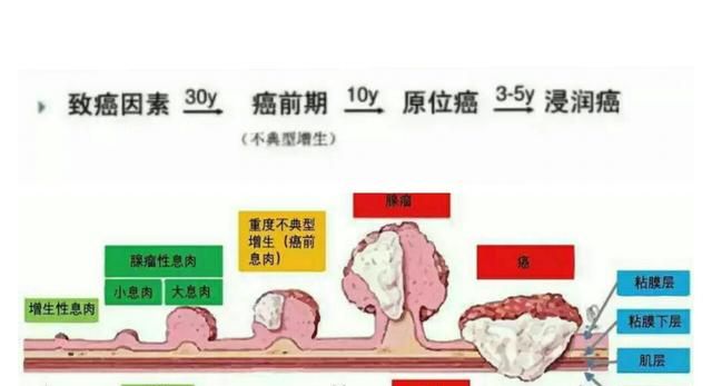结肠癌形成要几年,结肠癌最快形成需要几年图2