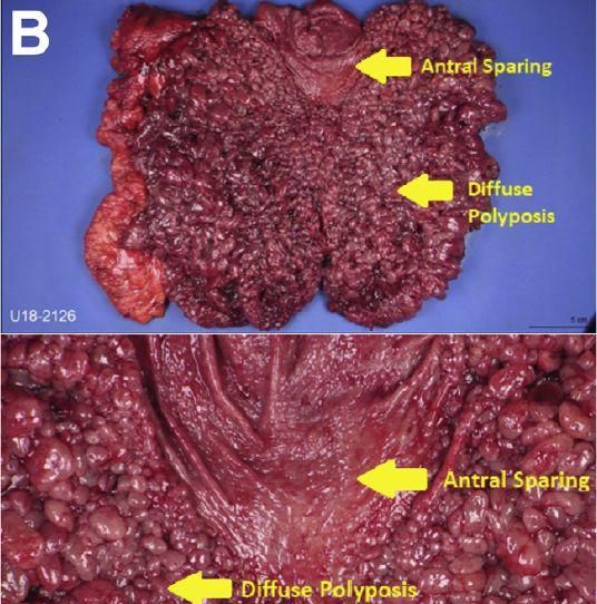 胃腺癌和胃近端息肉（gapps）：一种特殊的胃息肉病 | 病例学习