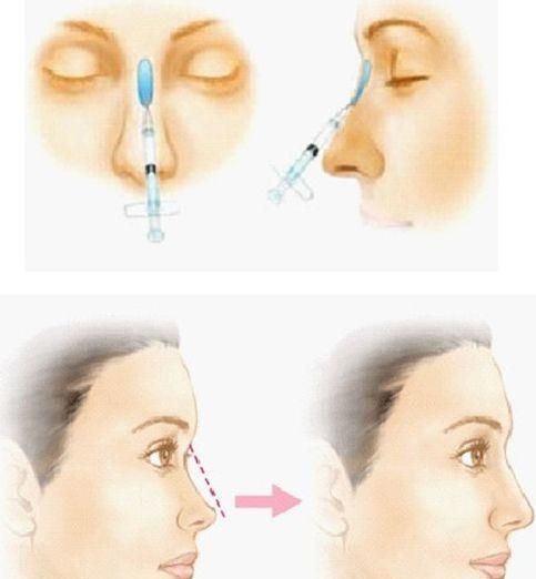 鼻翼变大，玻尿酸隆鼻会使鼻子变宽吗图4