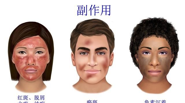 激光可以治疗痤疮（青春痘）吗？